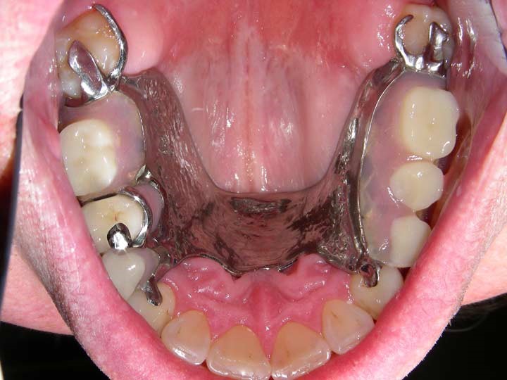 Partial Dentures For Back Teeth Elberta MI 49628